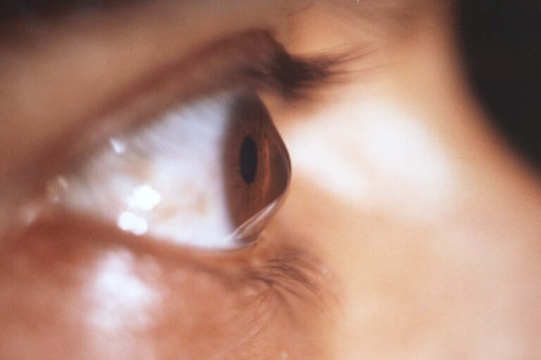 examen de l'oeil 1